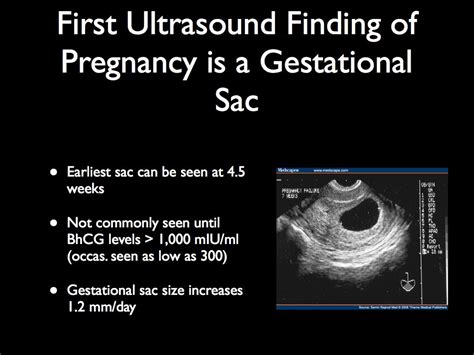 accuracy early ultrasound dating